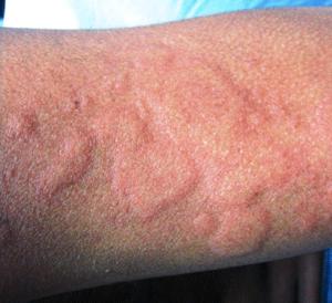 Видове алергии по тялото.  Алергия върху тялото