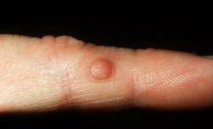 Kvrge na prstima (palac, srednji, kažiprst, mali prst): kako ih se riješiti i kako liječiti zglobove