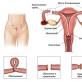 Podvezivanje jajovoda: posljedice za žene Ako su jajovodi podvezani, dolazi menstruacija