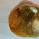 Dermoidna cista jajnika - koja prijetnja leži u ovoj formaciji