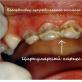 प्राथमिक दांतों का प्रारंभिक क्षय क्या है