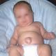 एक शिशु में नाभि हर्निया का इलाज कैसे करें: मालिश, ग्लूइंग, लोक तरीके