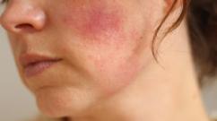 Mogućnost i ispoljavanje simptoma alergije na vitamine B (B), E, ​​A, lečenje i prevencija bolesti Alergija na licu od vitamina