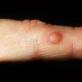 Kvrge na prstima (palac, srednji, kažiprst, mali prst): kako ih se riješiti i kako liječiti zglobove