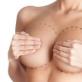 Rehabilitacija nakon mamoplastike: što očekivati?