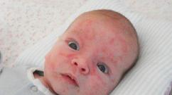 शिशुओं को किस चीज़ से एलर्जी होती है?