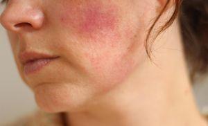Mogućnost i manifestacija simptoma alergije na vitamine B (B), E, ​​​​A, liječenje i prevencija bolesti Alergija na licu od vitamina