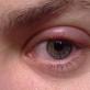 Edem očnog kapka - opis, simptomi, liječenje