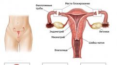 Podvezivanje jajovoda: posljedice za žene Ako su jajovodi podvezani, dolazi menstruacija