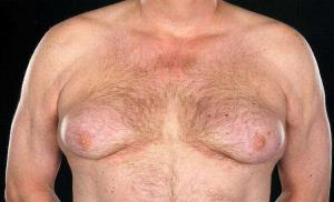स्तन ग्रंथि का गैलेक्टोरिआ: स्तन से पैथोलॉजिकल दूध स्राव का उपचार