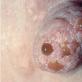 स्तन ग्रंथि की मास्टोपैथी मास्टोपैथी रोग का निदान